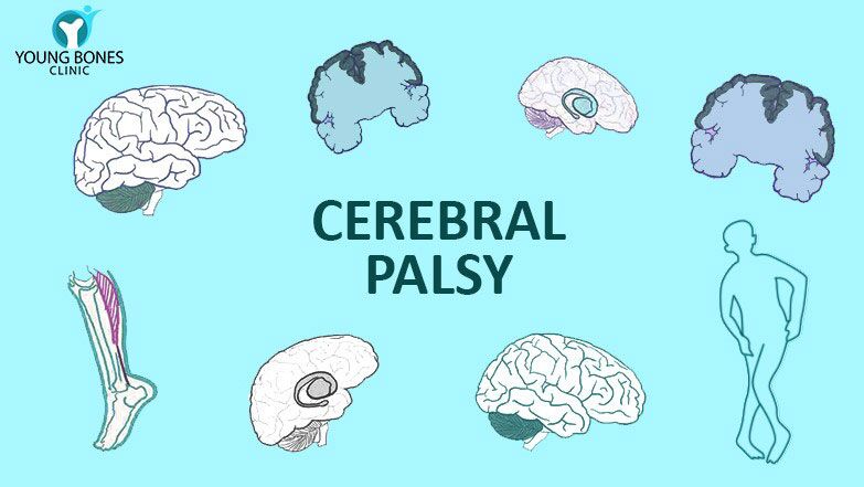 cerebral palsy children brain