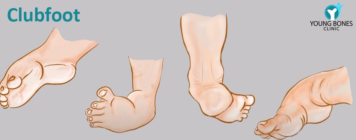 Club Foot Shoe with Splint Bar - Best Effective Treatment