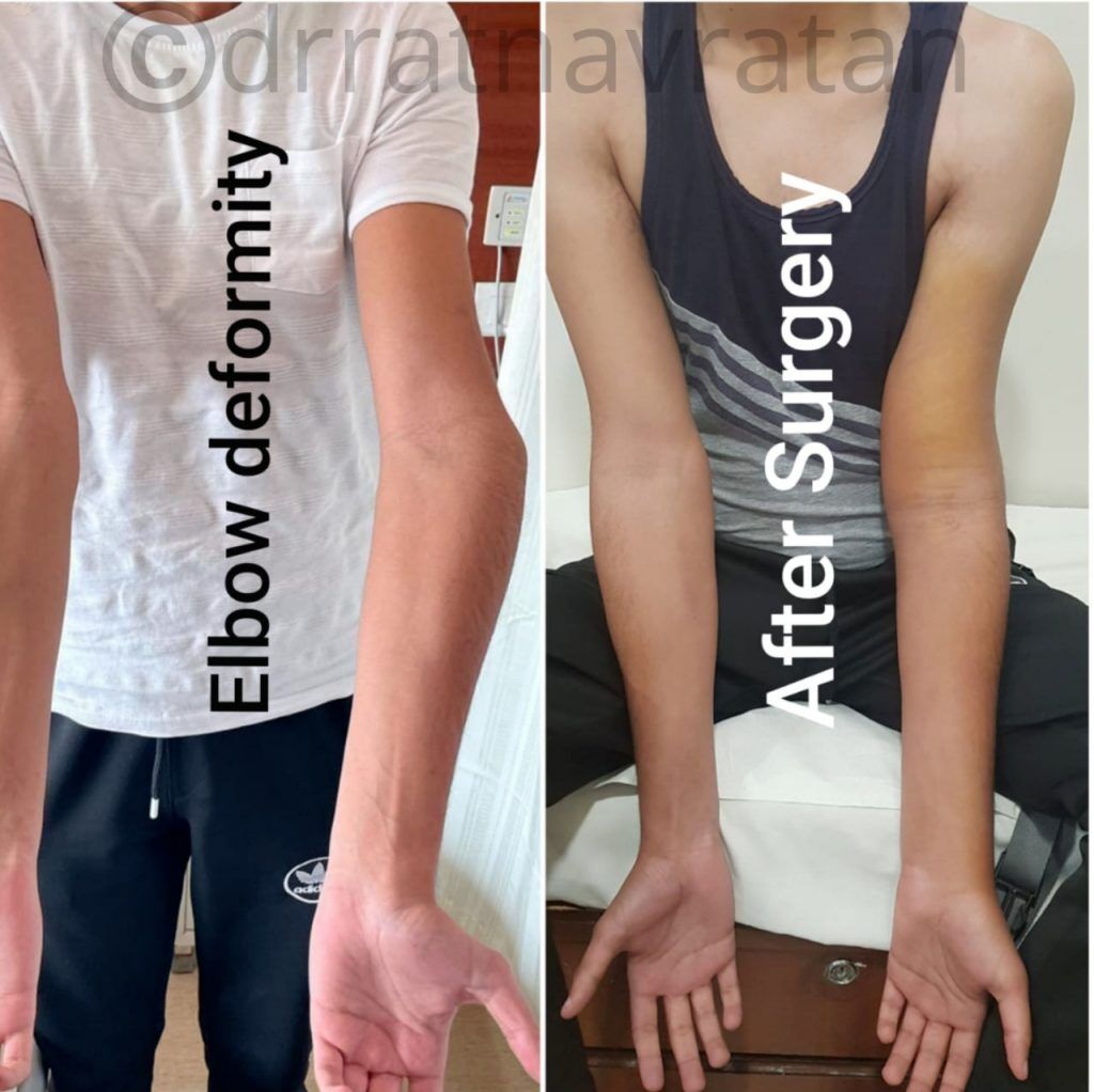 A Case of a 22-Year-old Boy with an Elbow Deformity since Childhood ...