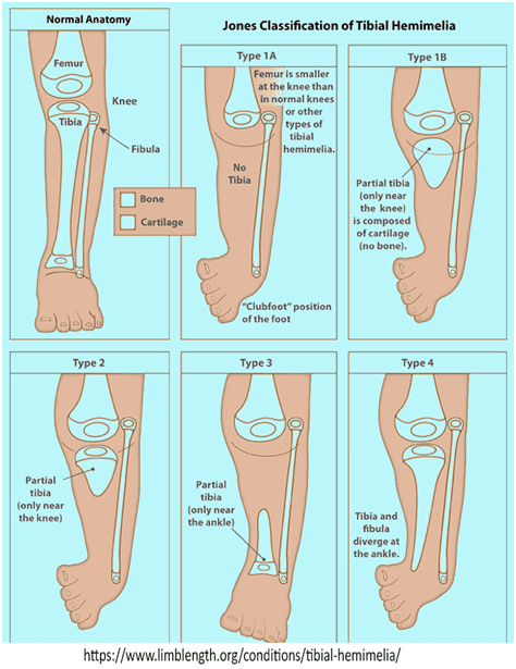 A CASE OF UNILATERAL TIBIAL HEMIMELIA WITH UNILATERAL RADIAL CLUB