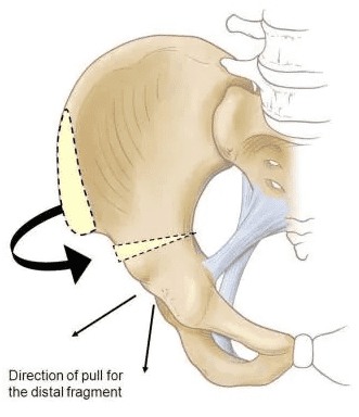 All about Legg-Calve-Perthes disease, a rare hip condition in growing ...