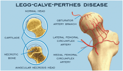 All about Legg-Calve-Perthes disease, a rare hip condition in growing
