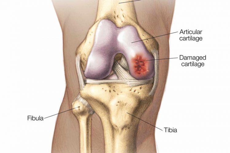 Exercises for Damaged Knee Cartilage
